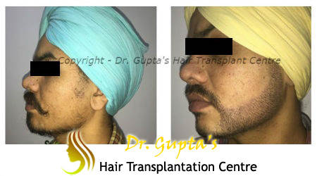 Welcome To Dr. Gupta's Hair Transplant Centre ::.