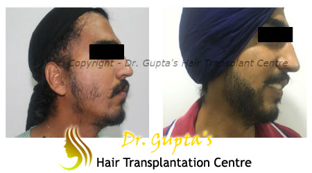 Welcome To Dr. Gupta's Hair Transplant Centre ::.